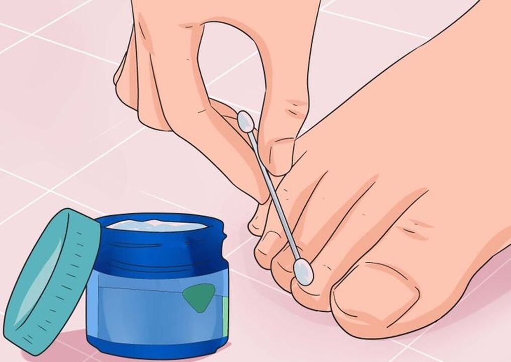 Cura ciuperca de unghii