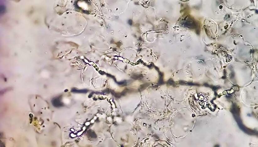 Ciupercile sub microscop - vinovatul în dezvoltarea micozei picioarelor